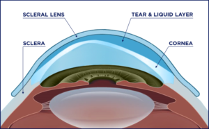 How Do Scleral Lenses Work?